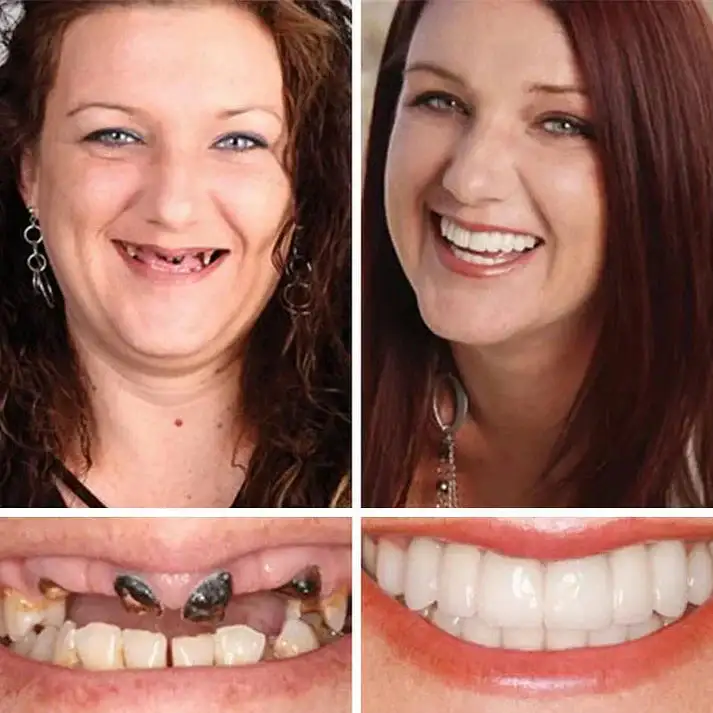 Custom-Fit Smile Support Set - Image 12
