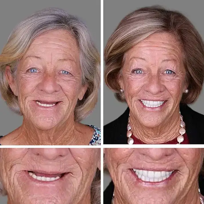 Custom-Fit Smile Support Set - Image 9