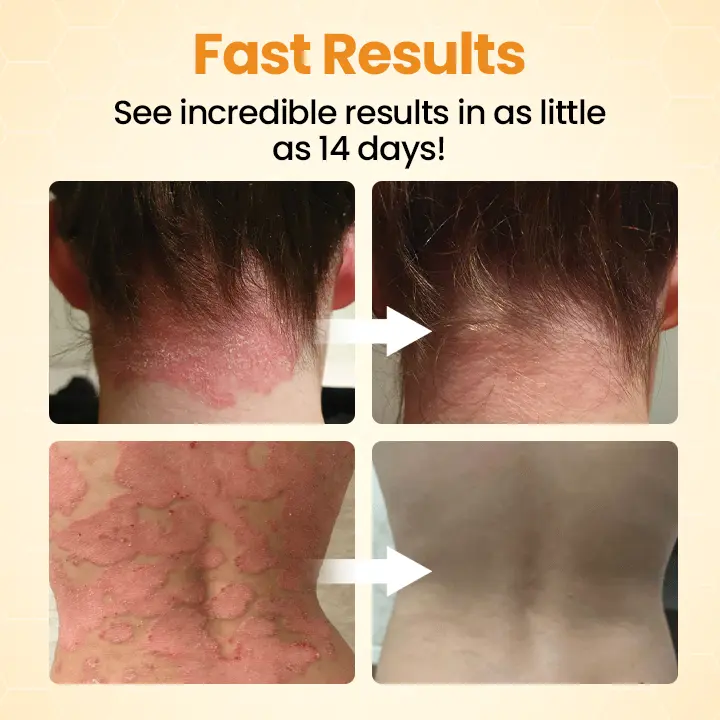 BeeLieve Psoriasis Skin Care - Image 2
