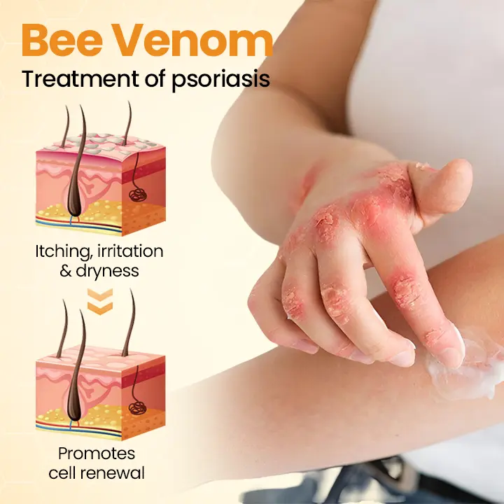 BeeLieve Psoriasis Skin Care - Image 6