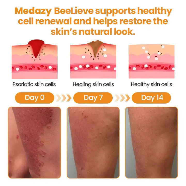BeeLieve Psoriasis Skin Care - Image 7
