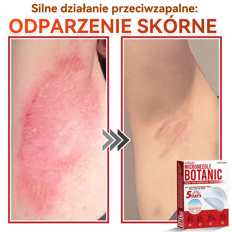 Patches for removing warts and moles using plant-based micro-needles - Image 10