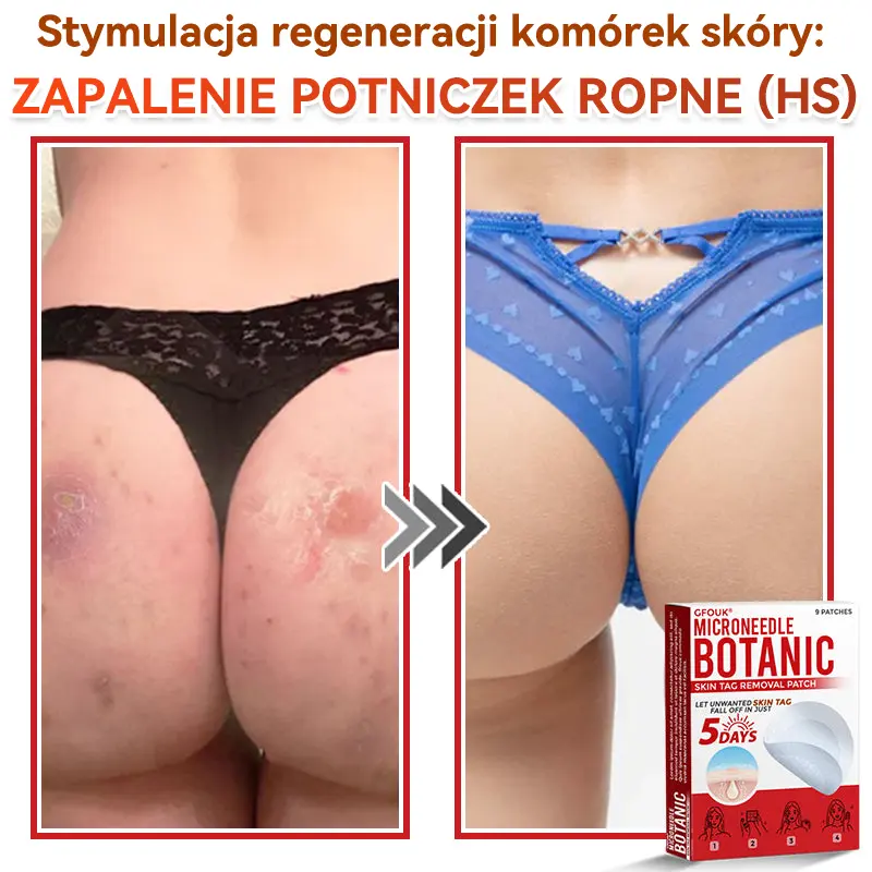 Patches for removing warts and moles using plant-based micro-needles - Image 11