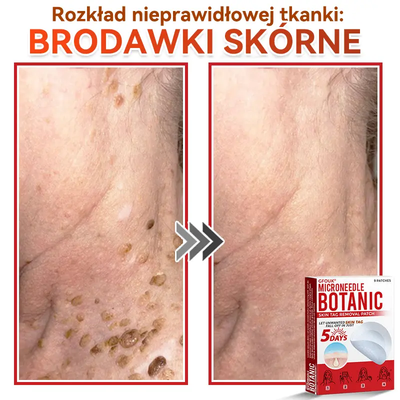 Patches for removing warts and moles using plant-based micro-needles - Image 3