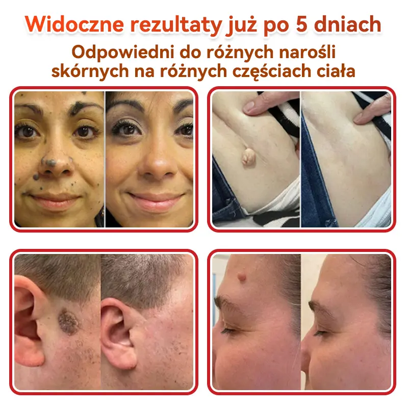 Patches for removing warts and moles using plant-based micro-needles - Image 4