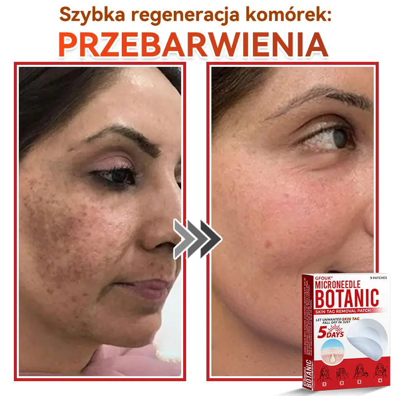 Patches for removing warts and moles using plant-based micro-needles - Image 5