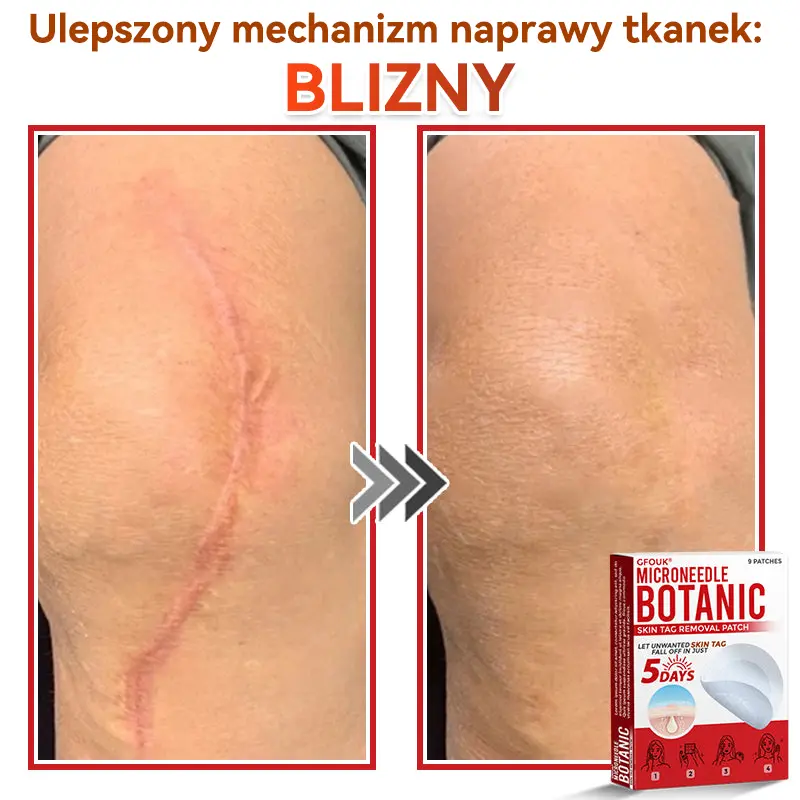 Patches for removing warts and moles using plant-based micro-needles - Image 7