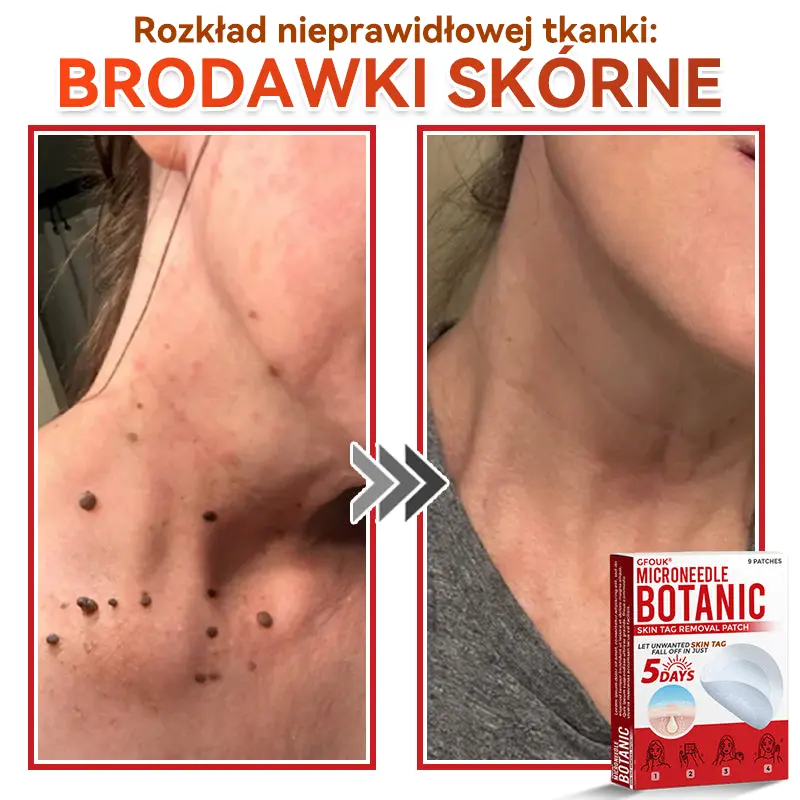 Patches for removing warts and moles using plant-based micro-needles - Image 9