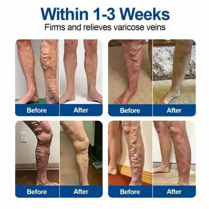 VeinEase Care Patch - Image 3