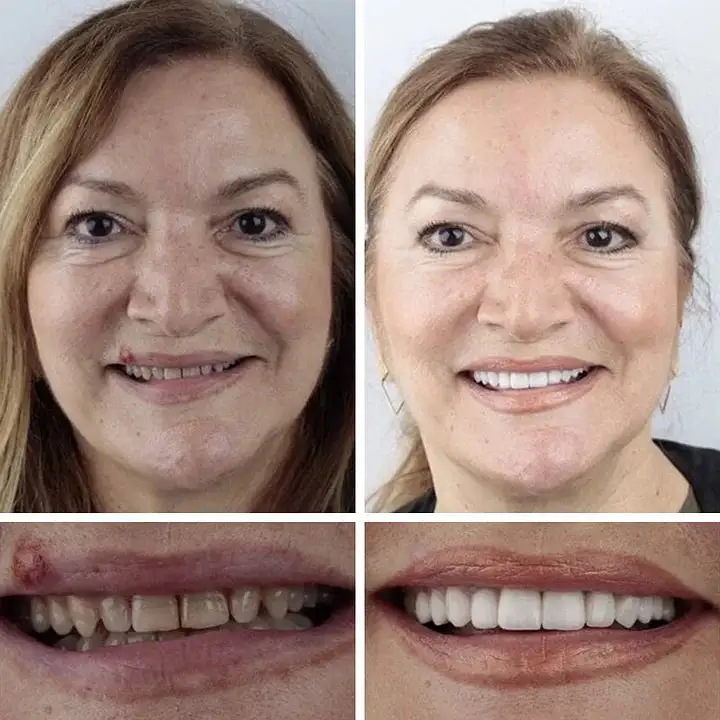 --Advanced Customized Full Denture Set - Image 11