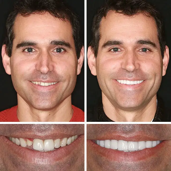 --Advanced Customized Full Denture Set - Image 5
