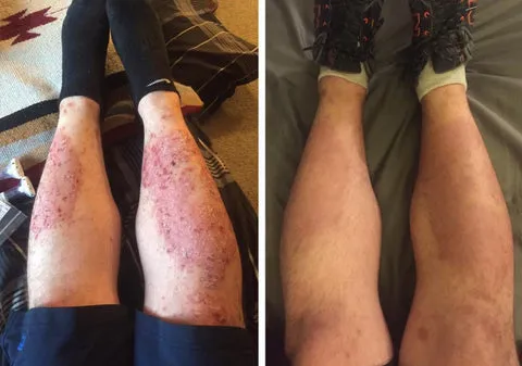 Psoriasis Treatment Spray - Image 3