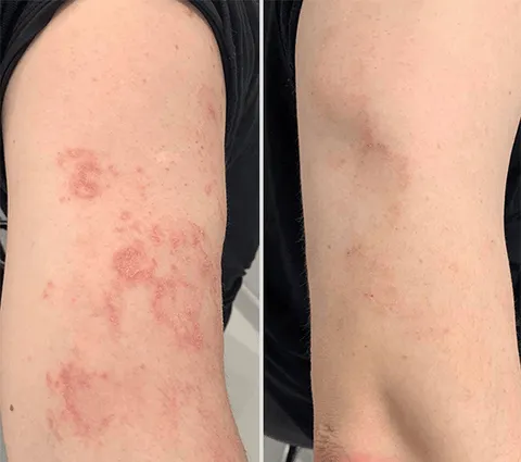 Psoriasis Treatment Spray - Image 2