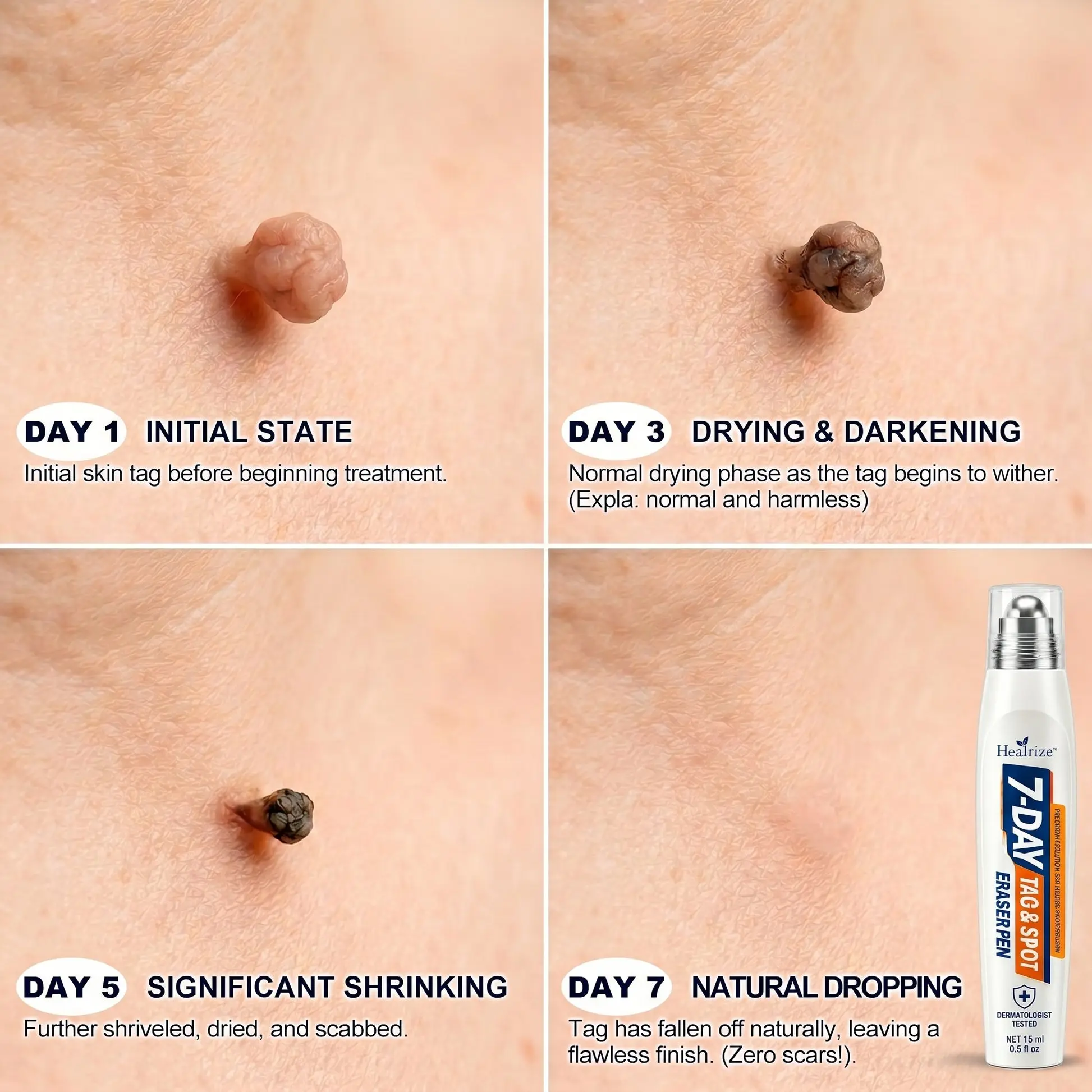 7-Day Skin Tag & Spot Eraser Painless & Scar-Free Advanced Imperfection Removal Rollerball Pen - Image 5