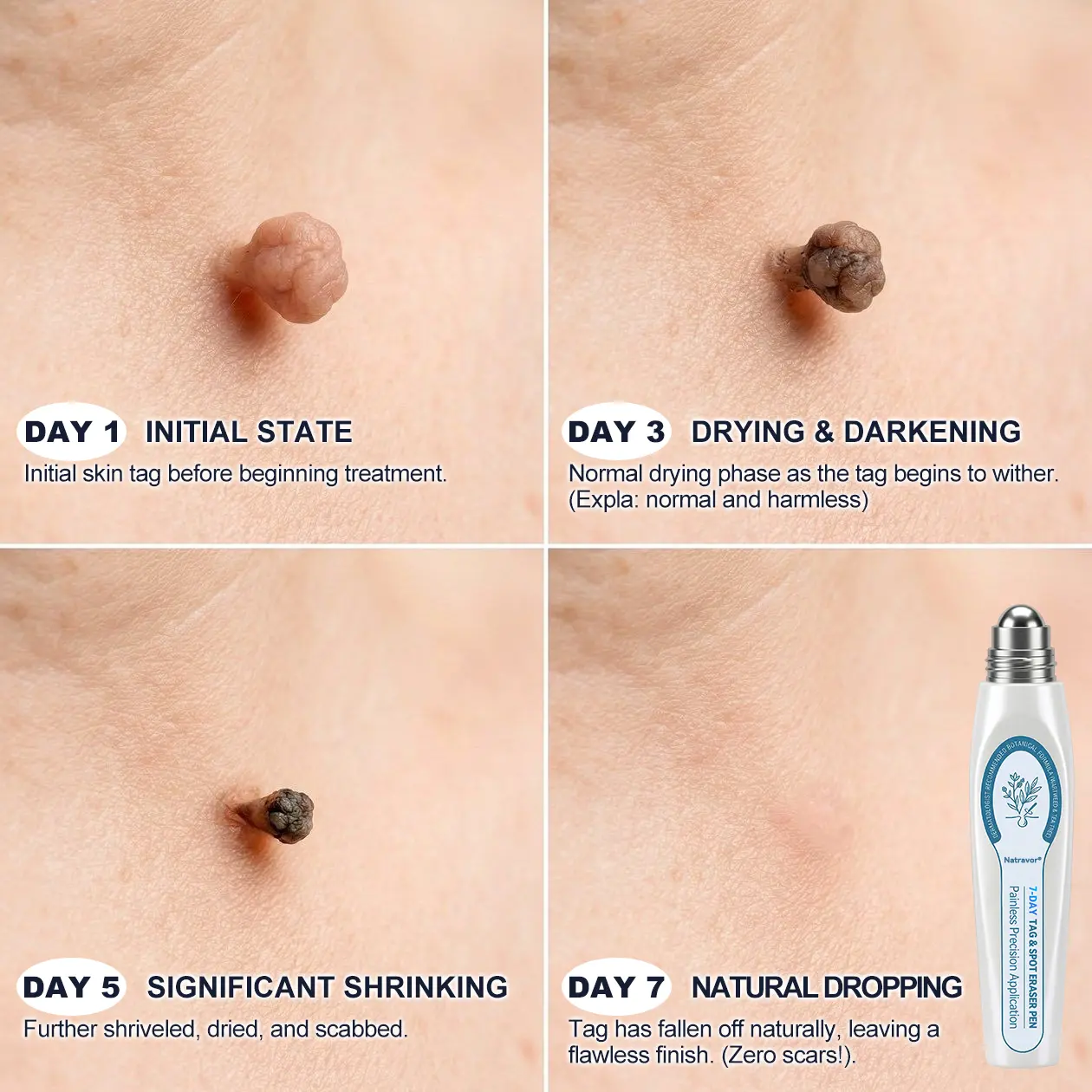 Skin Tag & Spot Appearance Support Pen - Image 4