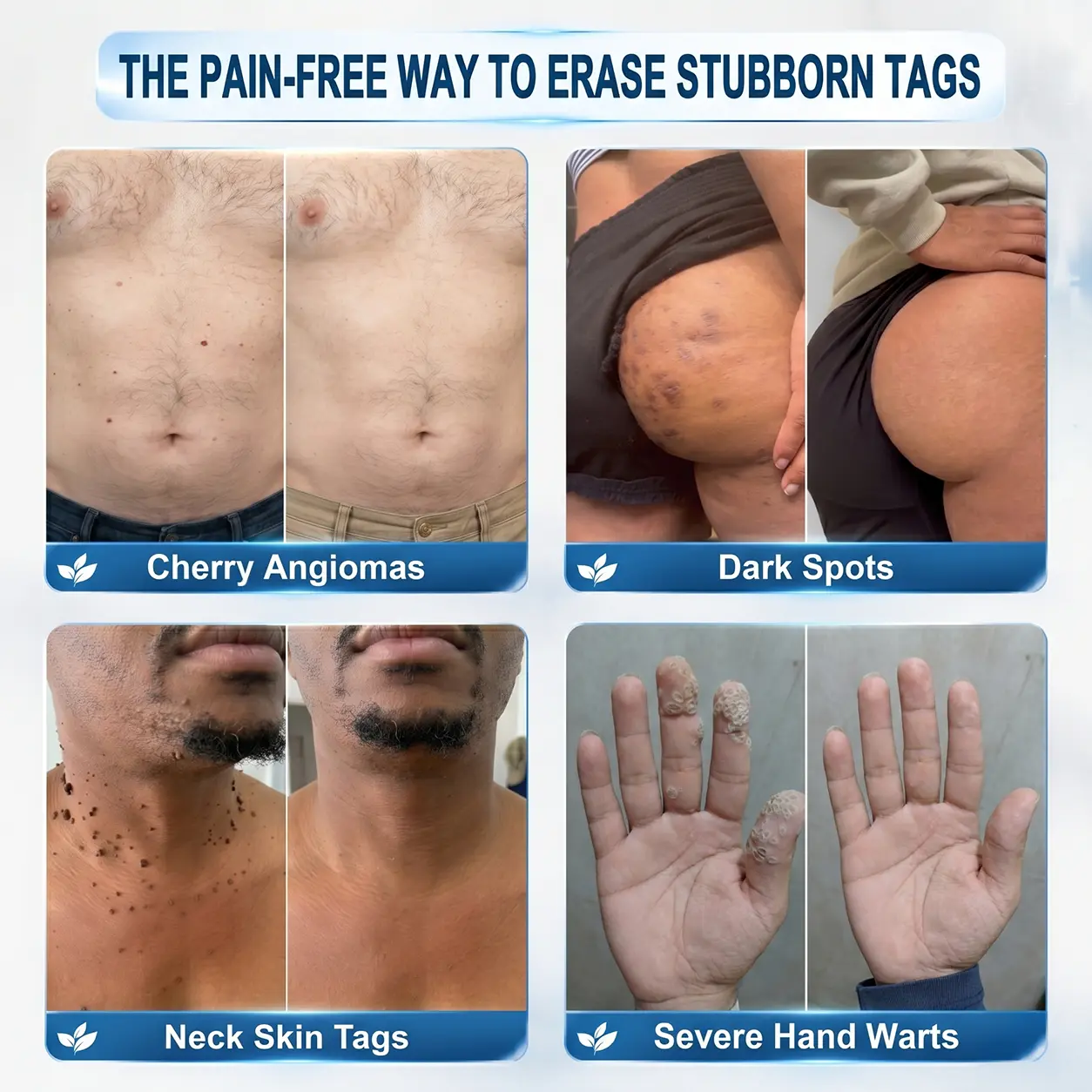 ๐-๐๐๐ ๐๐ธ๐ข๐ง ๐๐๐ด & ๐๐ฉ๐ค๐ญ ๐๐ซ๐๐ฌ๐๐ซ Painless & Scar-Free Advanced Imperfection Remova๐ Ro๐๐erba๐๐ Pen - Image 3
