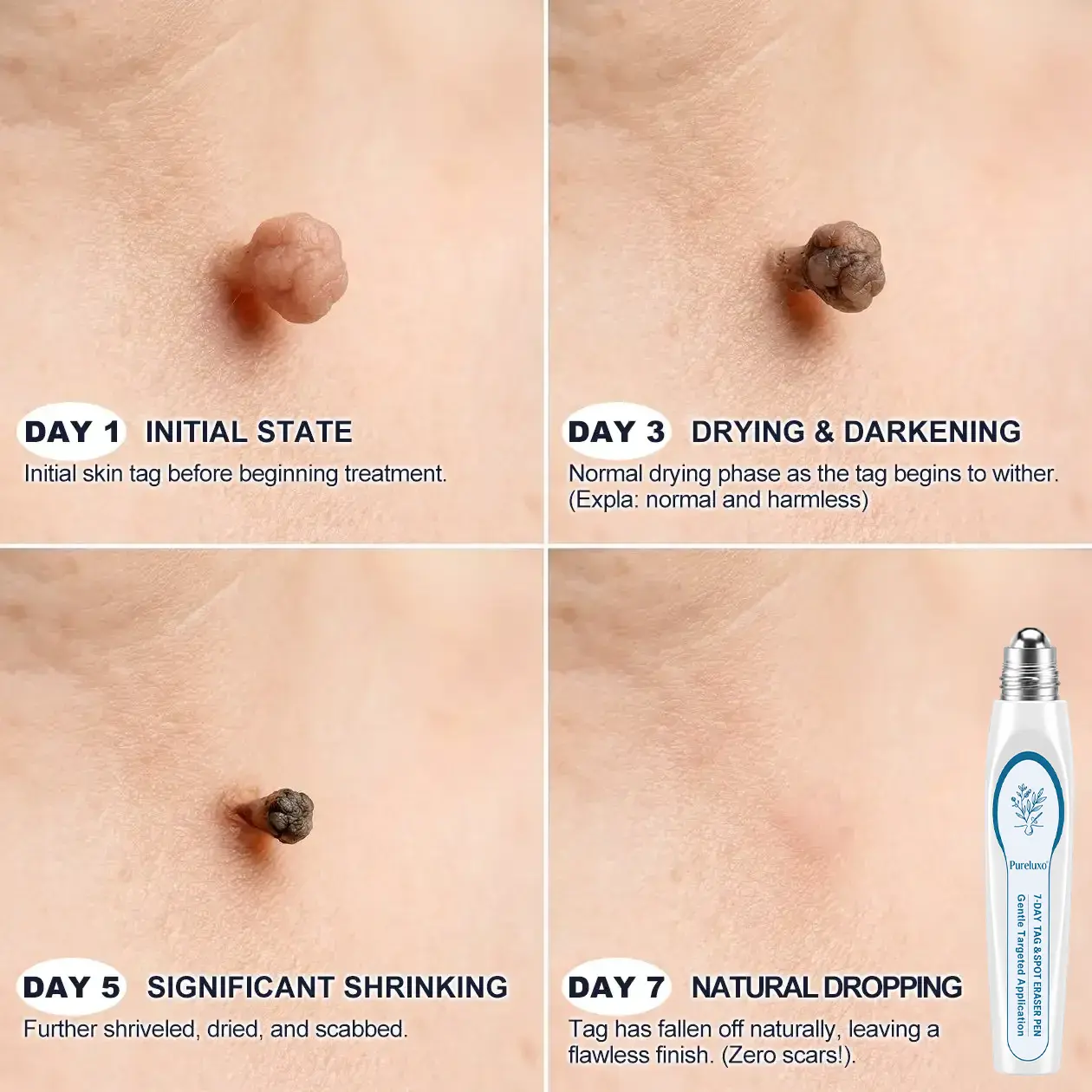 ๐-๐๐๐ ๐๐ธ๐ข๐ง ๐๐๐ด & ๐๐ฉ๐ค๐ญ ๐๐ซ๐๐ฌ๐๐ซ Painless & Scar-Free Advanced Imperfection Remova๐ Ro๐๐erba๐๐ Pen - Image 4