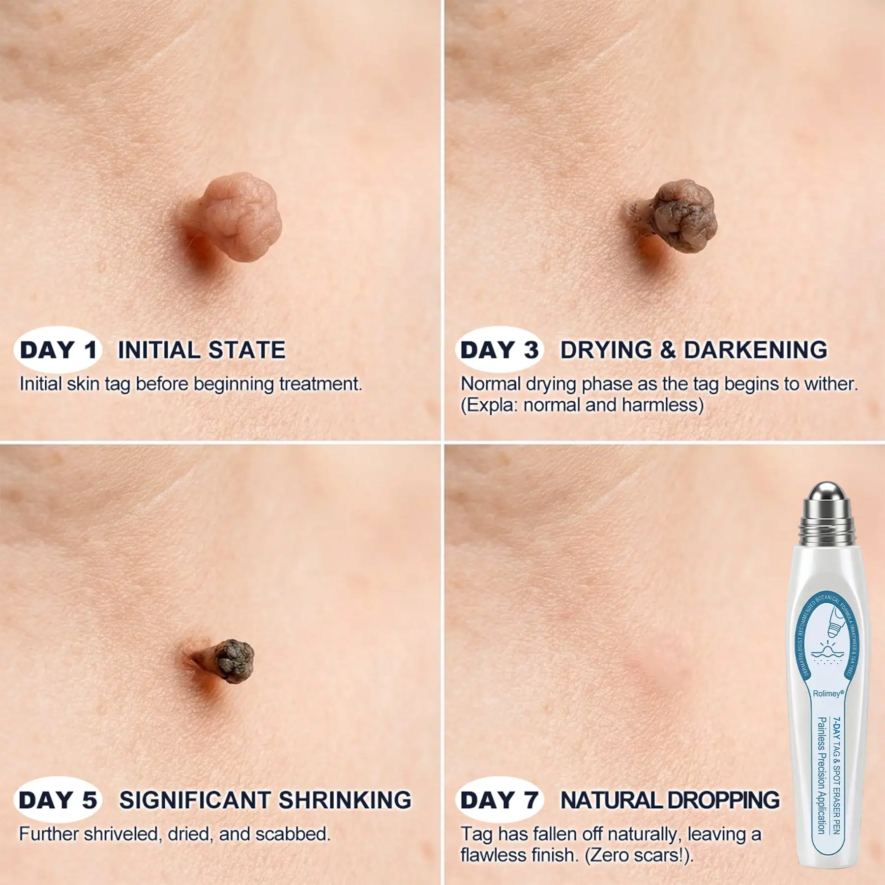 7-Day Skin Tag & Blemish Remover Painless & Scar-Free – Advanced Mole & Wart Remover - Image 4