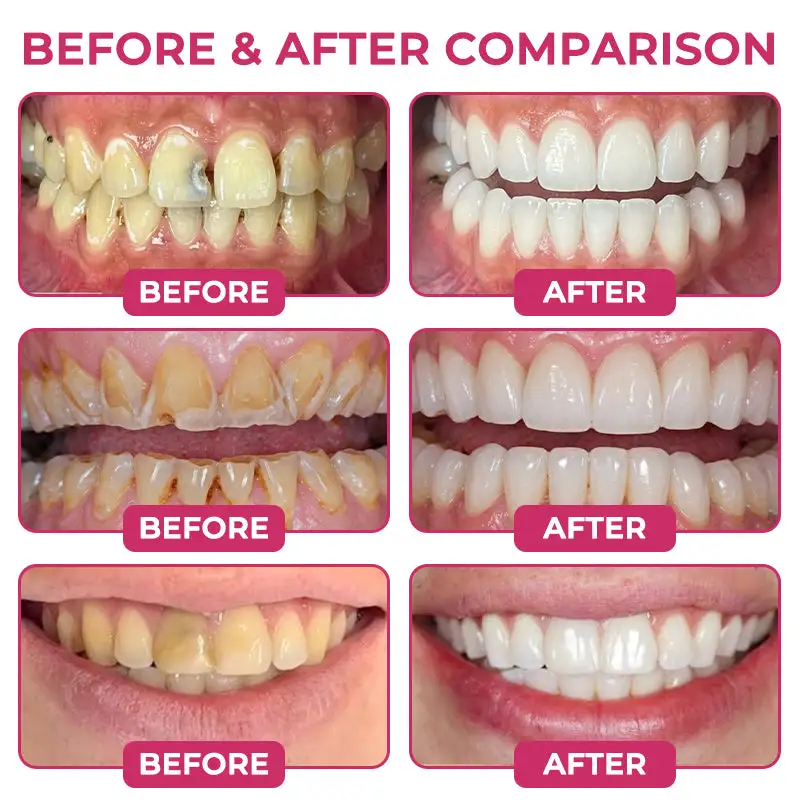 KLENIMORE DenPerm Cavity-Repair Natural Gel - Image 3