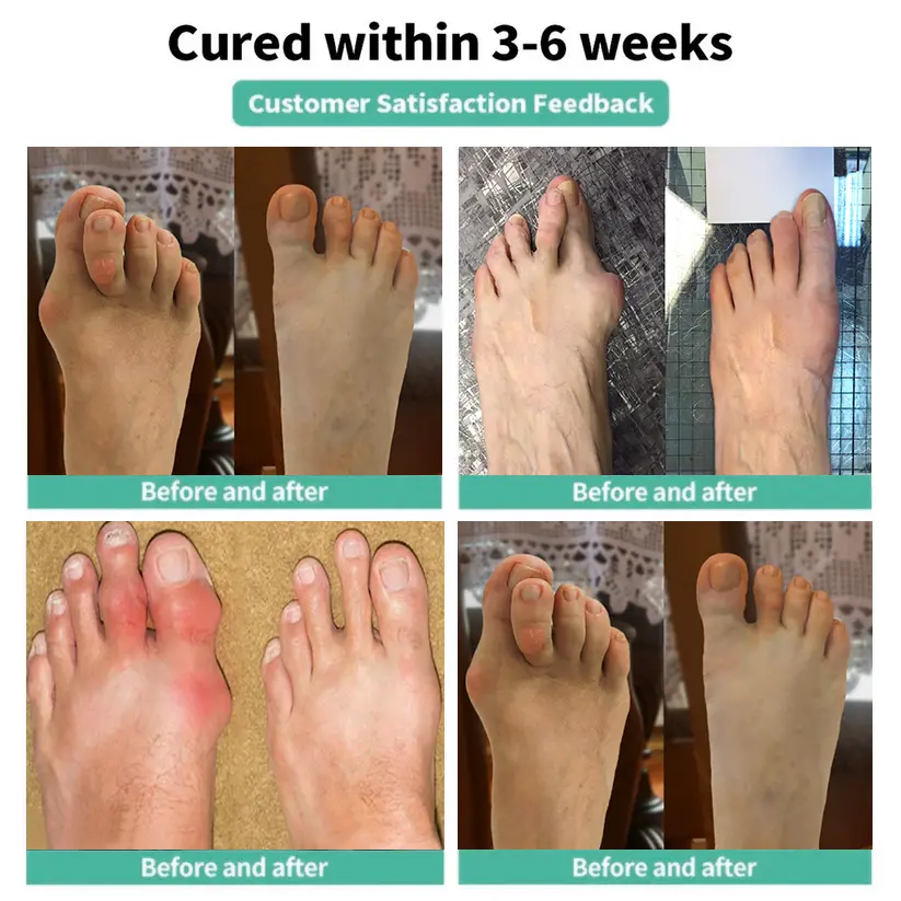 Bunion Comfort Patch - Image 4