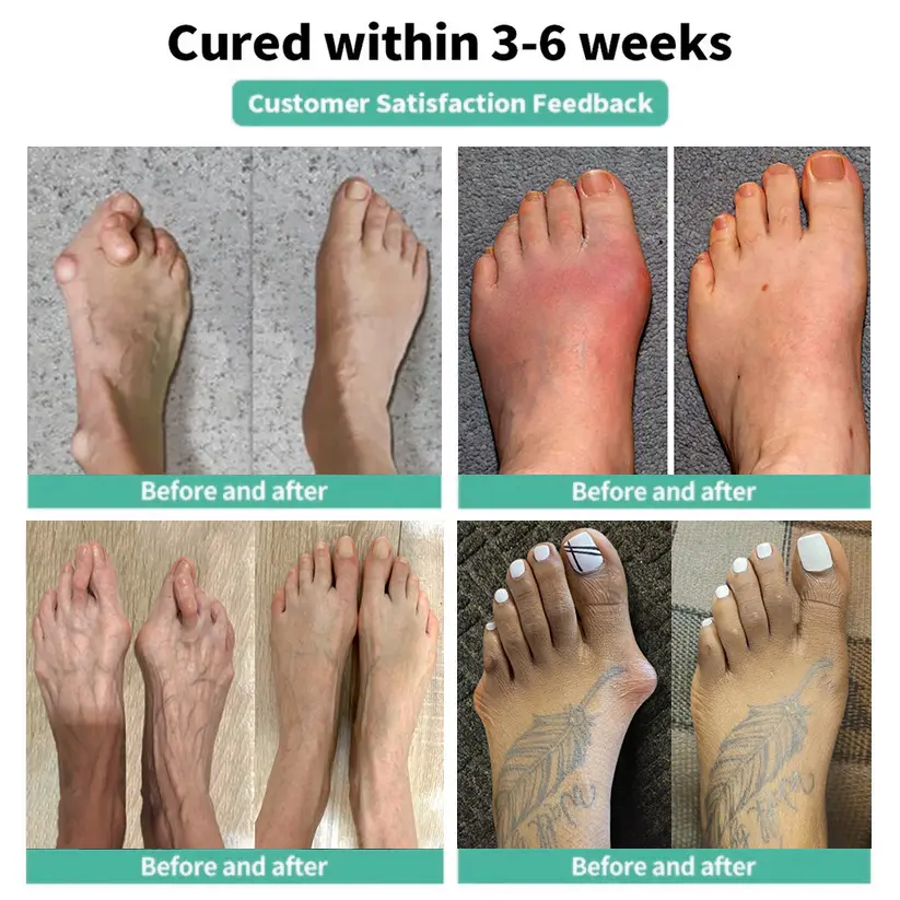 Bunion Comfort Patch - Image 5