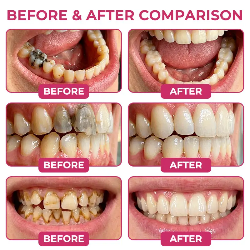 DenPerm Cavity-Repair Natural Gel - Image 3