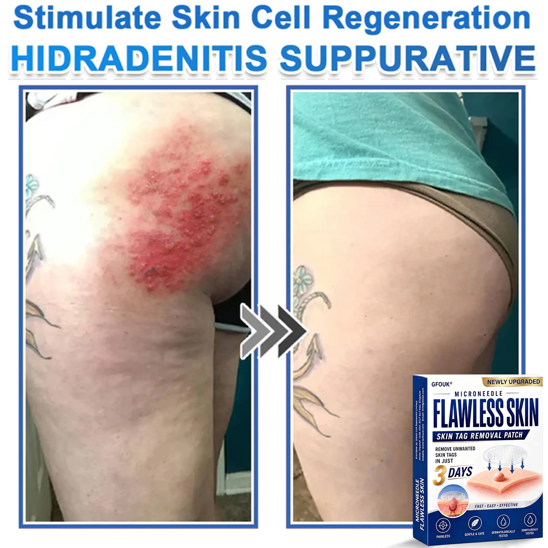 2026 Newly Upgraded 2-in-1 Hydrocolloid Patches - Image 10