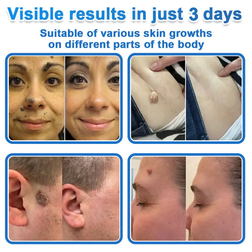 2026 Newly Upgraded 2-in-1 Hydrocolloid Patches - Image 3