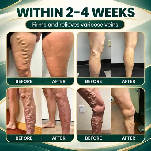 Varicose Veins Cream - Image 4